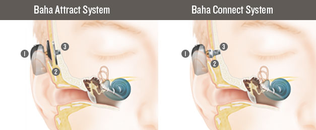 Baha® kemik iletimli implantlar­